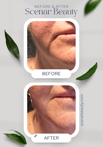 Scenar Beauty Results The changes in 4 sessions.